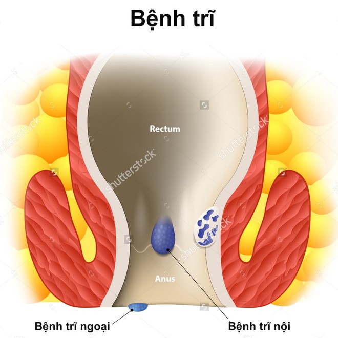 Mắc bệnh trĩ, táo bón chỉ vì dùng điện thoại trong khi đi vệ sinh - Ảnh 2.