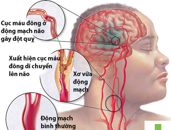 Bác sĩ cảnh báo căn bệnh nguy hiểm chết người sau khi uống rượu - Ảnh 2.