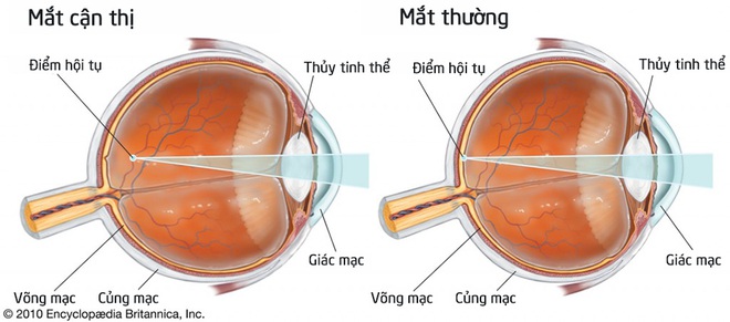 Cận thị 20 đi ốp do di truyền có nhiều ở Việt Nam - Ảnh 1.