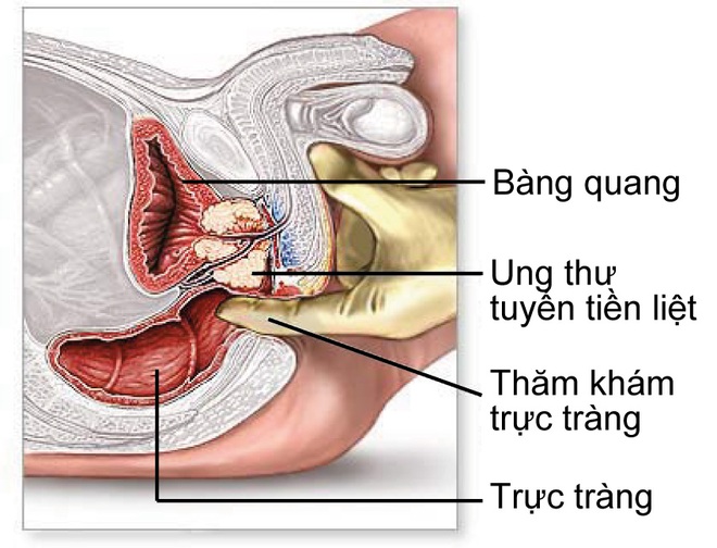 Bác sĩ khuyên bạn cách ăn uống để tránh xa bệnh về tuyến tiền liệt - Ảnh 2.