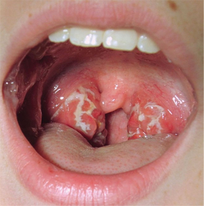Đừng coi thường những vết loét trong miệng, đó có thể là dấu hiệu của 1 căn bệnh ung thư! - Ảnh 1.