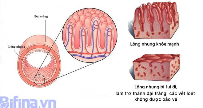 Không còn nỗi lo viêm đại tràng lâu năm nhờ cách của người Nhật - Ảnh 2.