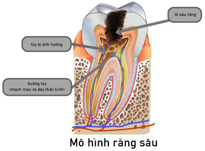 Sâu răng hình thành như thế nào? - Ảnh 3.