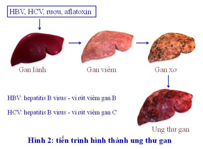 Biết mình bị ung thư gan, xin đừng nằm chờ chết - Ảnh 3.