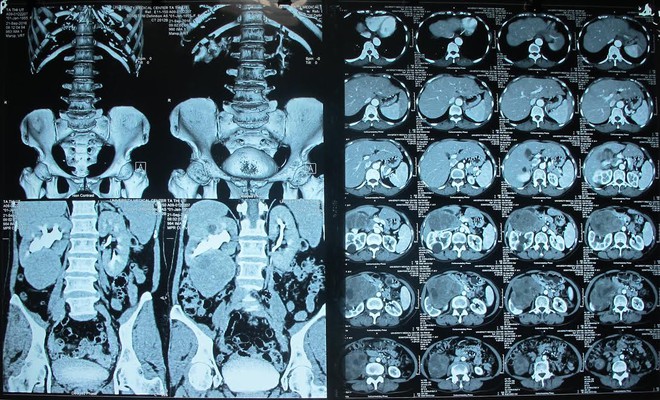 Đau bụng cả năm, đi khám mới biết bị u thận khổng lồ - Ảnh 1.