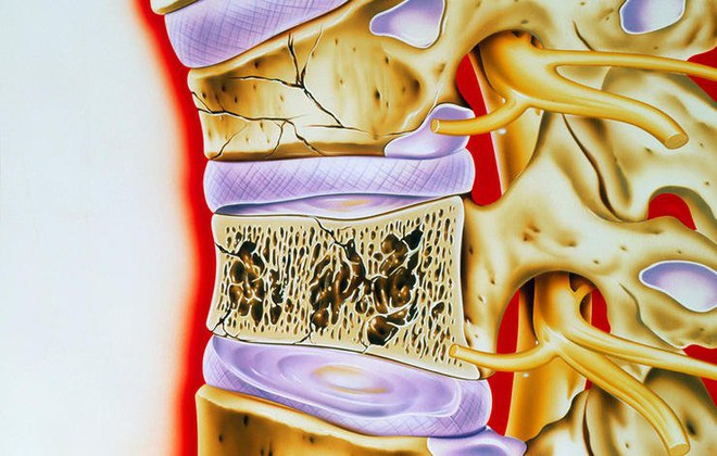 5 căn bệnh nguy hiểm đằng sau mỗi cơn đau lưng: Đừng chủ quan! - Ảnh 2.