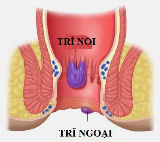 Chuyên gia mách bạn cách điều trị đúng bệnh trĩ - Ảnh 2.