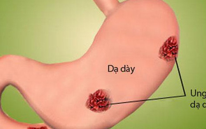 Không chỉ gây bệnh tim mạch, ăn mặn nguy cơ mắc bệnh ung thư nguy hiểm - Ảnh 1.