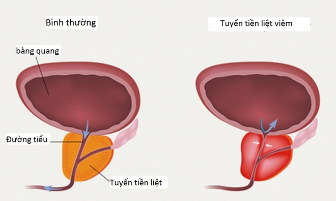 Nam giới khổ nhất là khi mắc phải căn bệnh này, nhớ làm ngay 3 việc để tránh rủi ro - Ảnh 2.