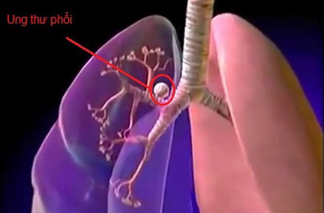 Cách phân biệt giữa ho thông thường và ho cảnh báo dấu hiệu sớm của bệnh ung thư phổi - Ảnh 1.