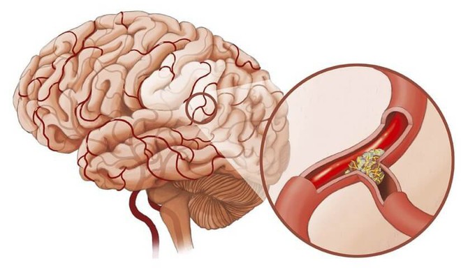 5 triệu chứng cảnh báo mạch máu bị tắc, cần xử lý ngay để tránh tử vong bất ngờ - Ảnh 1.