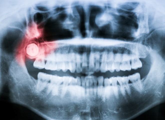 Đây là những cách để giảm sự hoành hành của chiếc răng ngu - Ảnh 1.