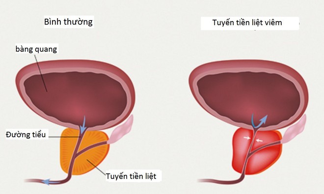 Căn bệnh nguy hiểm lặng lẽ tấn công 4 nhóm người, không đối phó sớm sẽ thành mãn tính - Ảnh 1.