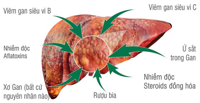 70 - 80% ca mắc ung thư gan xuất phát từ nguyên nhân này, hãy phòng tránh ngay từ hôm nay - Ảnh 2.