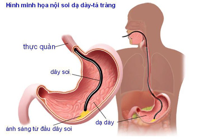 6 nhóm người có nguy cơ cao mắc ung thư dạ dày, đừng để khối u làm tổ rồi mới đi khám - Ảnh 3.