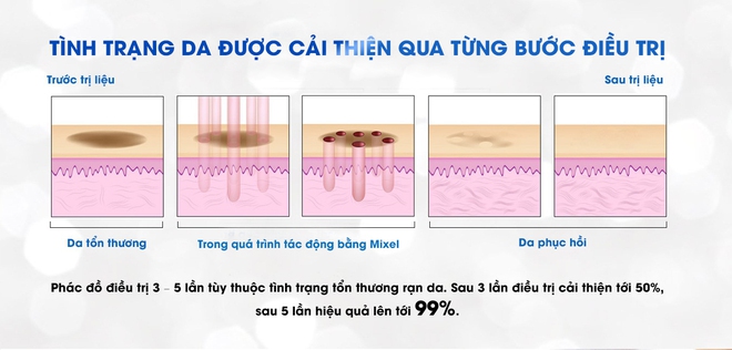 Đột phá trong công nghệ trị rạn da biến ước mơ bikini của bạn thành hiện thực - Ảnh 2.