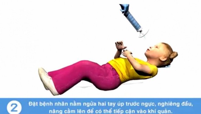 Tử vong do sặc cháo: Nếu biết cách cấp cứu kịp thời có thể cứu mạng trẻ - Ảnh 3.