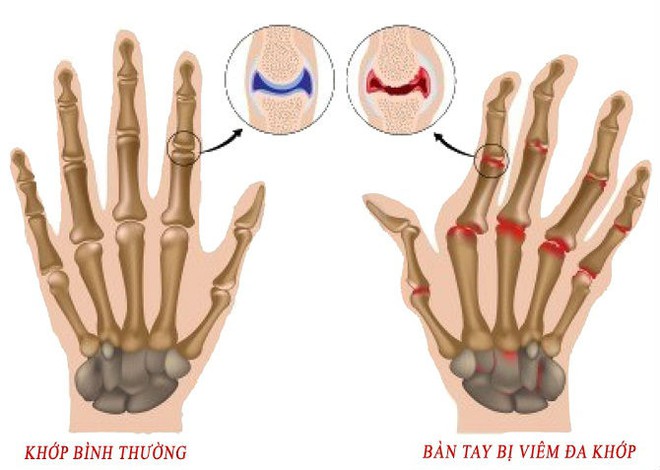 Biên tập viên bị hủy khớp tay do… gõ bàn phím quá nhiều - Ảnh 2.