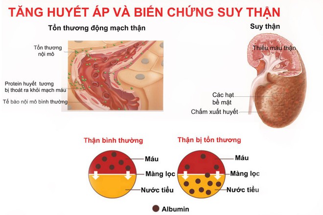 Tăng huyết áp và những biến chứng khó lường - Ảnh 1.