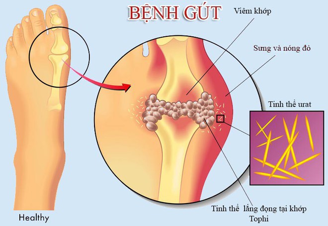 Hoàng Tiên Đan: Giải pháp hiệu quả cho người mắc gút - Ảnh 3.