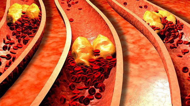 Mạch máu tắc thì tuổi thọ ngắn: Giải pháp hiệu quả để thông tắc huyết quản bạn nên áp dụng - Ảnh 2.