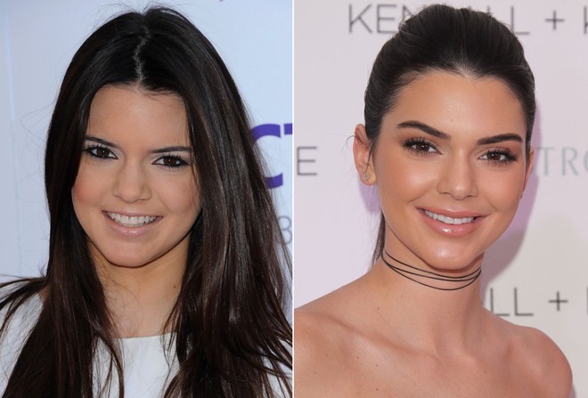 Hậu bơm môi sửa mặt, Kendall Jenner bắt đầu xuống sắc vì di chứng thẩm mỹ? - Ảnh 2.