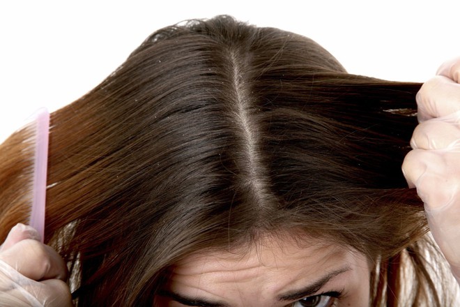Đừng chủ quan nếu thấy tóc rụng nhiều bởi đó có thể là dấu hiệu của một vài bệnh lý nguy hiểm - Ảnh 3.