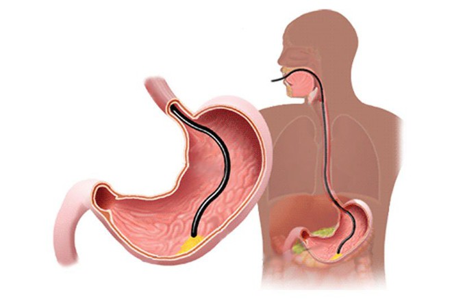 Viêm dạ dày lâu ngày có thể dẫn tới ung thư: Phát hiện và chữa kịp thời nhờ 8 dấu hiệu - Ảnh 2.