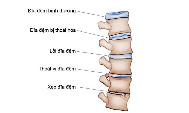 Chuyện bệnh nhân lâu năm chữa trị thoái hóa cột sống hiệu quả - Ảnh 1.