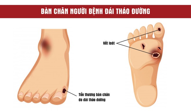 5 sai lầm khi chăm sóc bàn chân người tiểu đường mùa lạnh - Ảnh 1.