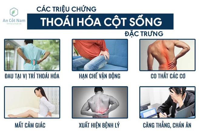 Thoái hóa cột sống là gì? Nguyên nhân, triệu chứng và cách chữa dứt điểm - Ảnh 2.