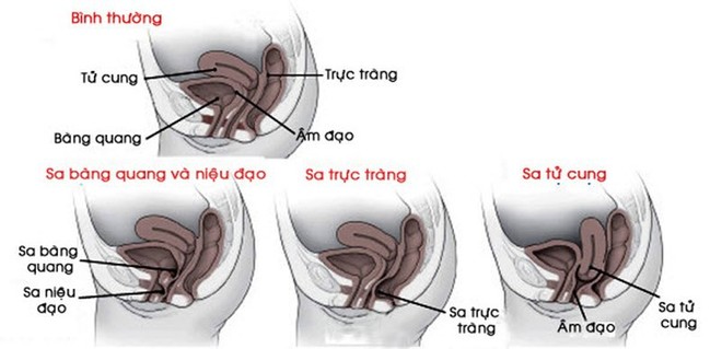 Sa tạng chậu: Nữ 20 tuổi chưa sinh nở vẫn bị - Ảnh 1.