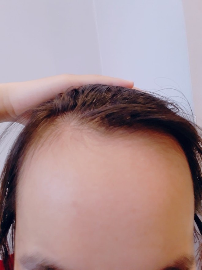 Hướng dẫn xử lý tóc BUNG 3 XOÁY hiệu quả nhất  YouTube