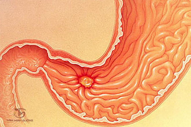 Bệnh viêm hang vị dạ dày - Nguyên nhân, triệu chứng và cách chữa trị dứt điểm - Ảnh 1.