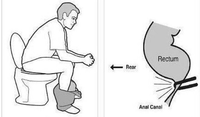 Sai lầm phổ biến trong tư thế đi vệ sinh có thể gây bệnh - Ảnh 1.