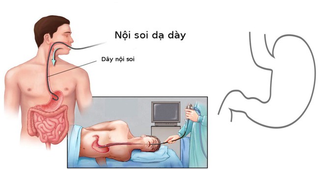 Mỗi ngày có thêm 48 người Việt bị ung thư dạ dày: Làm điều này để trừ bệnh từ trứng nước - Ảnh 2.
