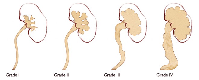 4 dấu hiệu cảnh báo thận bị ứ nước có thể khiến bạn gặp nguy hiểm: Hãy khẩn trương đi khám - Ảnh 2.