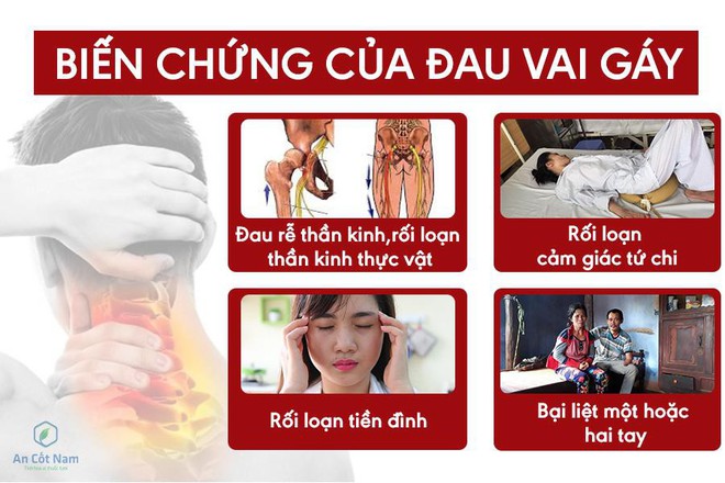 Đau vai gáy: Nguyên nhân và cách chữa trị hiệu quả - Ảnh 1.