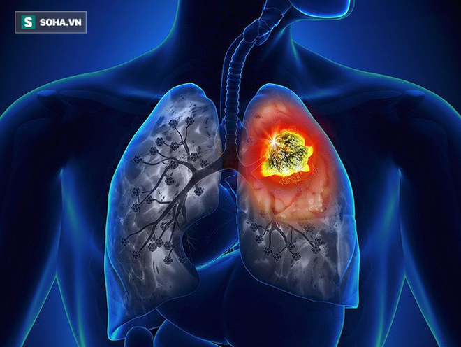 Hơn 20.000 người Việt tử vong do ung thư phổi mỗi năm: Phát hiện bệnh sớm để sống lâu hơn - Ảnh 1.