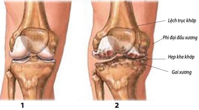 Cách kiểm soát thoái hóa khớp - Ảnh 1.