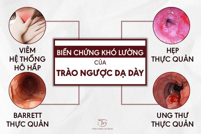 Bệnh trào ngược dạ dày thực quản uống thuốc gì an toàn, hiệu quả? - Ảnh 1.