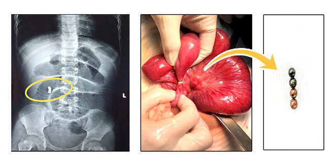 Bác sĩ cảnh báo: Viên bi nam châm đồ chơi cho trẻ em hiểm họa khôn lường - Ảnh 1.
