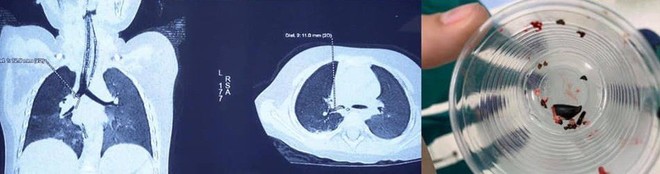 Chuyên gia cảnh báo: Trẻ nhỏ hóc hạt, ho sặc nghẹt đường thở doạ tử vong - Ảnh 2.