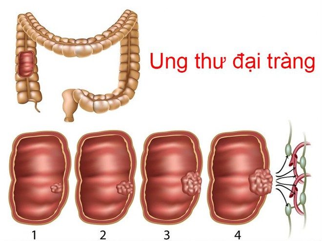 5 nhóm người dễ bị ung thư đại trực tràng, bác sĩ mong rằng không có bạn trong số đó - Ảnh 1.