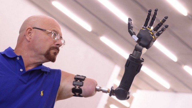 Người đàn ông đầu tiên trên thế giới sống với cánh tay robot điều khiển bằng trí não - Ảnh 1.