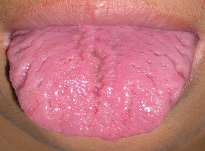Khi thấy dấu hiệu này trên lưỡi, hãy cẩn thận với bệnh dạ dày và khẩn trương đi khám - Ảnh 2.