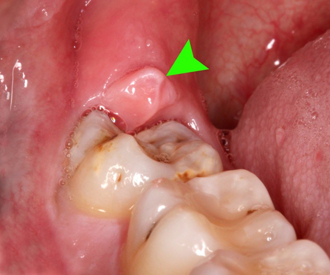 Răng số 8 có hay biến chứng? Khi nào biến chứng răng số 8 có thể gây tử vong? - Ảnh 1.