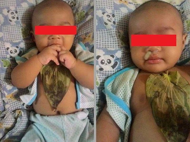 Gây hại con trẻ vì tin vào bài thuốc dân gian - Ảnh 1. Gây hại con trẻ vì tin vào bài thuốc dân gian - Ảnh 1.
