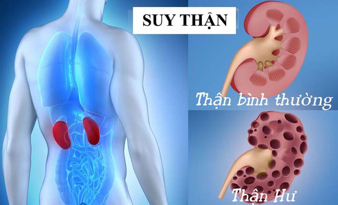 Bệnh thận - căn bệnh gây đau đớn ám ảnh: Làm ngay 4 điều này để phòng bệnh - Ảnh 1.