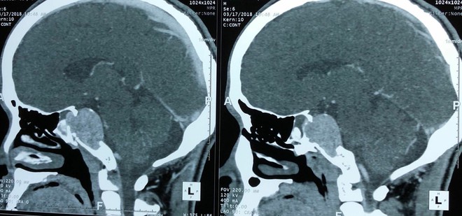 Cảnh báo: Chủ quan với bệnh đau đầu, đi khám phát hiện khối u não lớn - Ảnh 1.